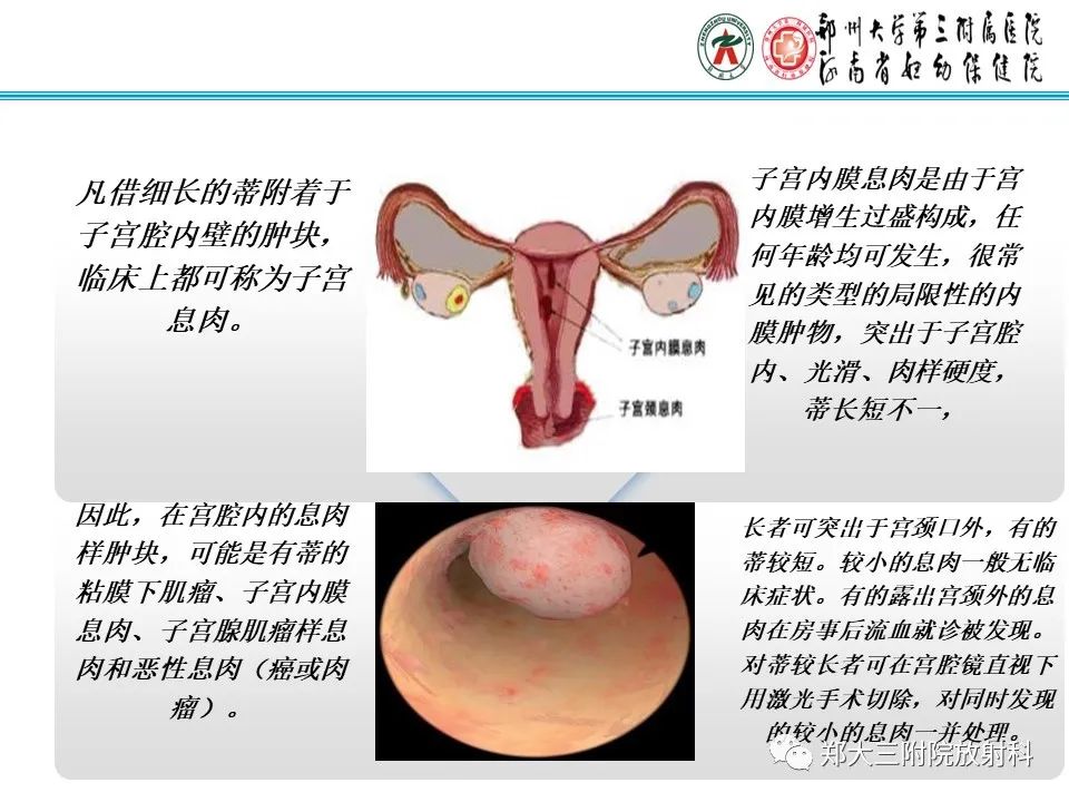 影像PPT - 【病例】子宫内膜息肉1例MR影像表现-10