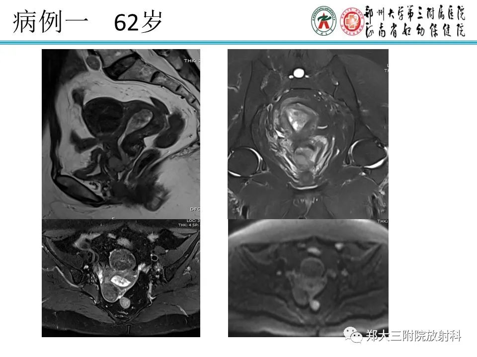 影像PPT - 【病例】子宫内膜息肉1例MR影像表现-16
