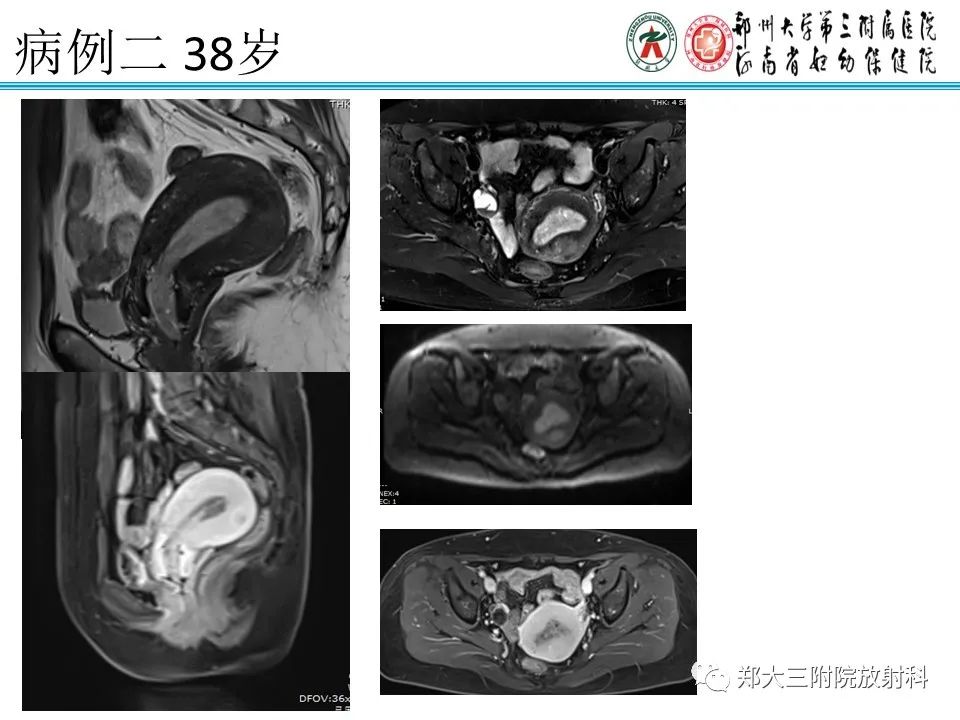 影像PPT - 【病例】子宫内膜息肉1例MR影像表现-17