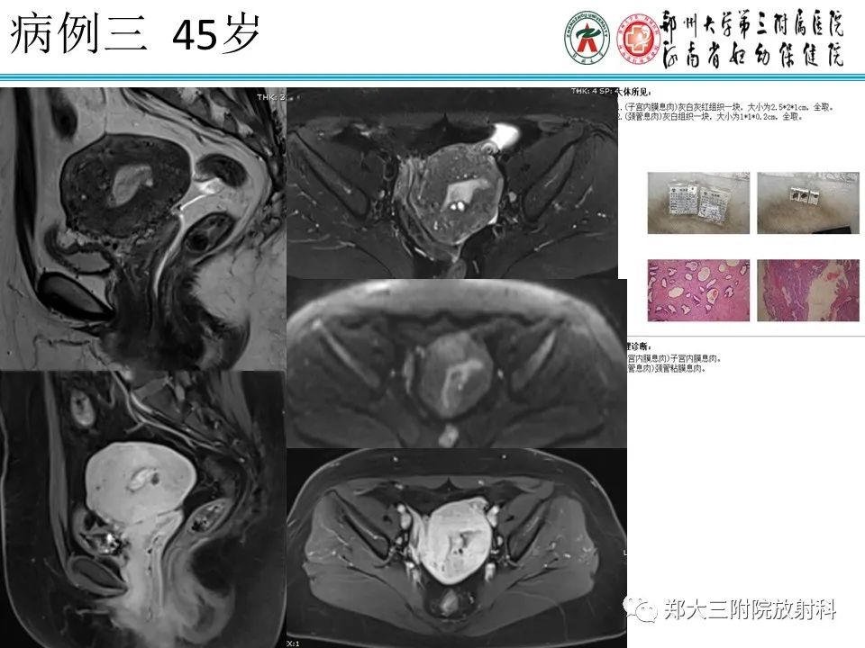 影像PPT - 【病例】子宫内膜息肉1例MR影像表现-18