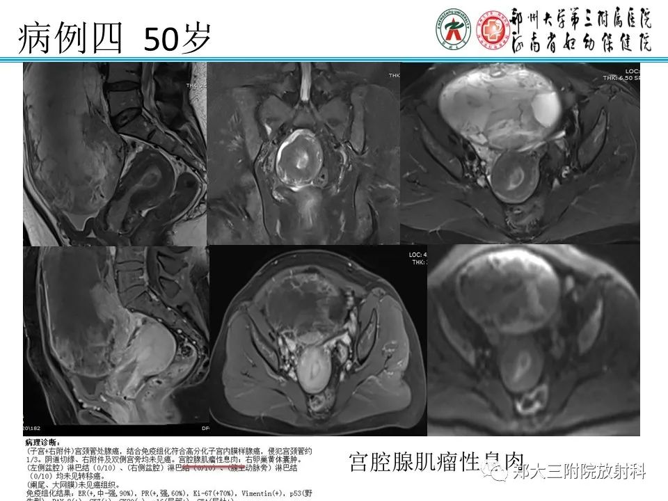 影像PPT - 【病例】子宫内膜息肉1例MR影像表现-19