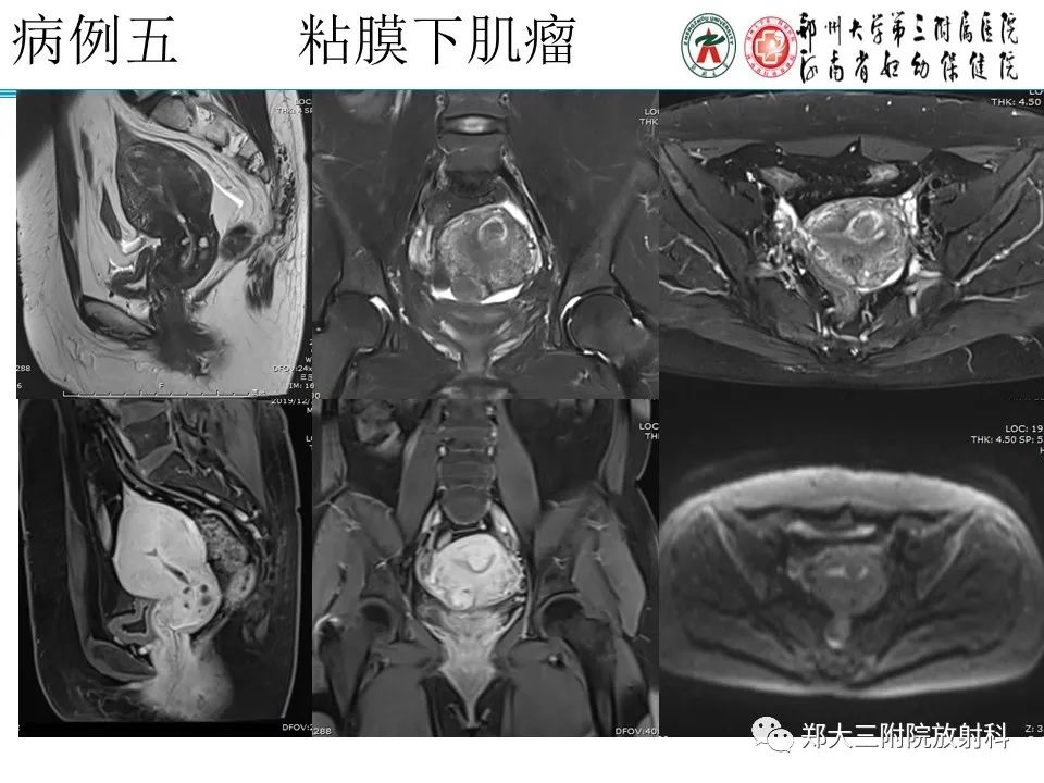 影像PPT - 【病例】子宫内膜息肉1例MR影像表现-24