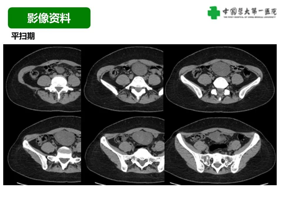 影像PPT - 【病例】肠道神经鞘瘤1例CT影像-3