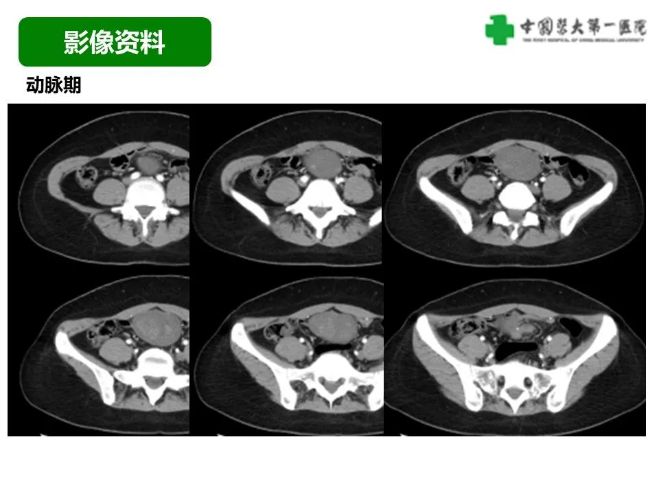 影像PPT - 【病例】肠道神经鞘瘤1例CT影像-4