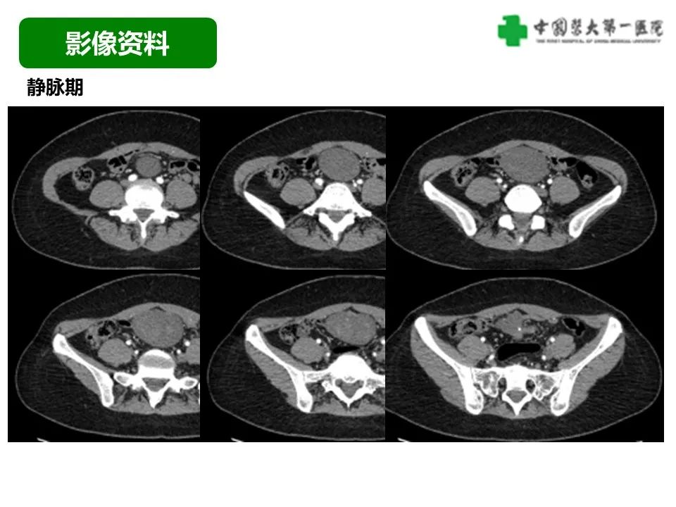 影像PPT - 【病例】肠道神经鞘瘤1例CT影像-5