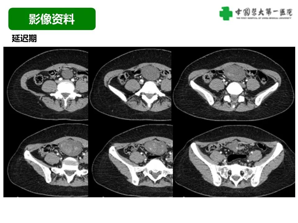 影像PPT - 【病例】肠道神经鞘瘤1例CT影像-6