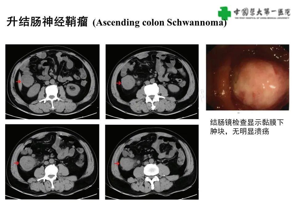 影像PPT - 【病例】肠道神经鞘瘤1例CT影像-15