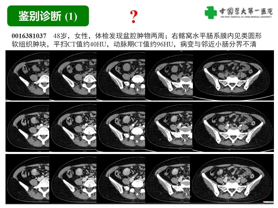 影像PPT - 【病例】肠道神经鞘瘤1例CT影像-16