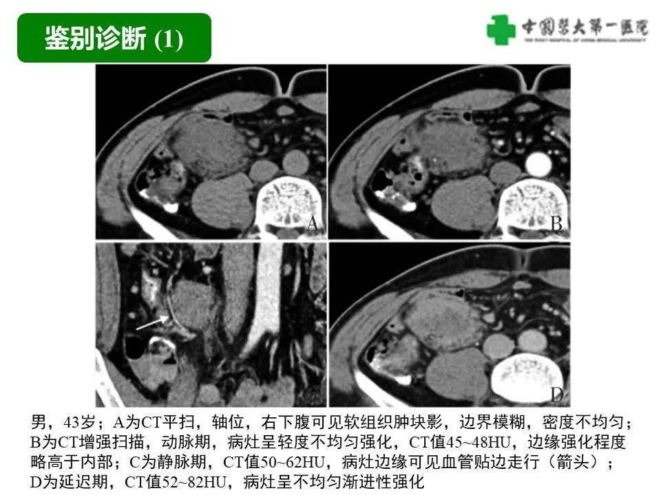 影像PPT - 【病例】肠道神经鞘瘤1例CT影像-19