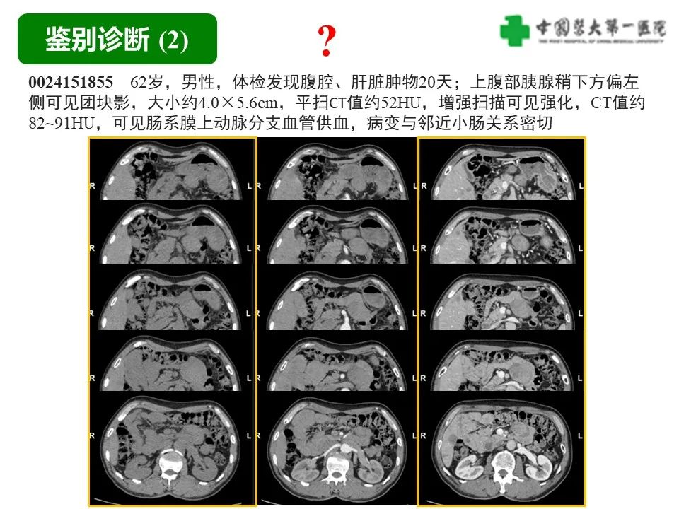 影像PPT - 【病例】肠道神经鞘瘤1例CT影像-20