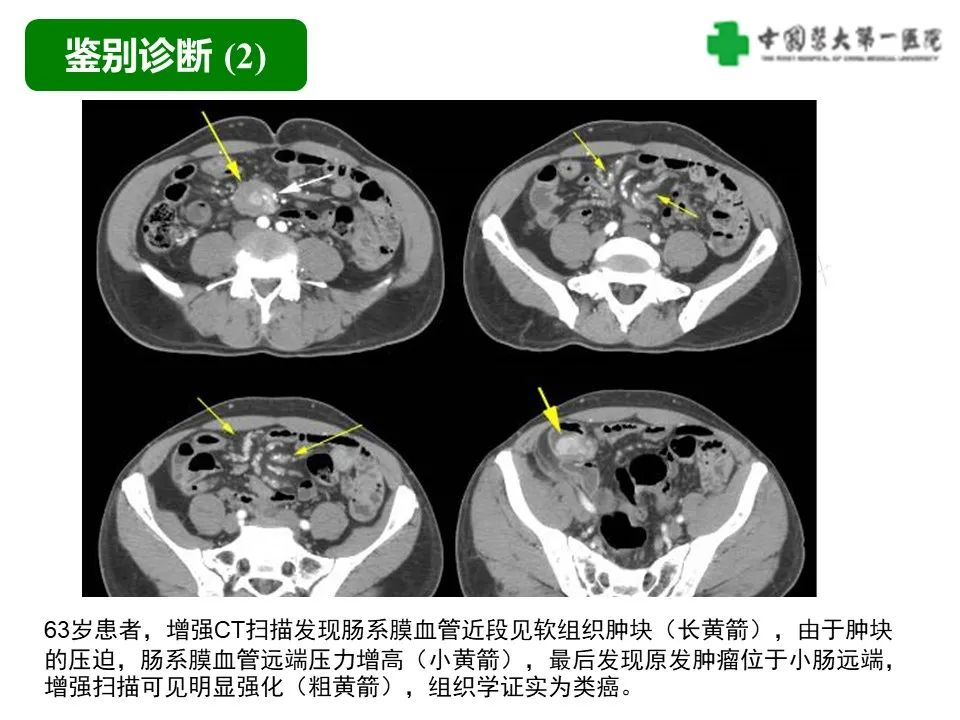 影像PPT - 【病例】肠道神经鞘瘤1例CT影像-23