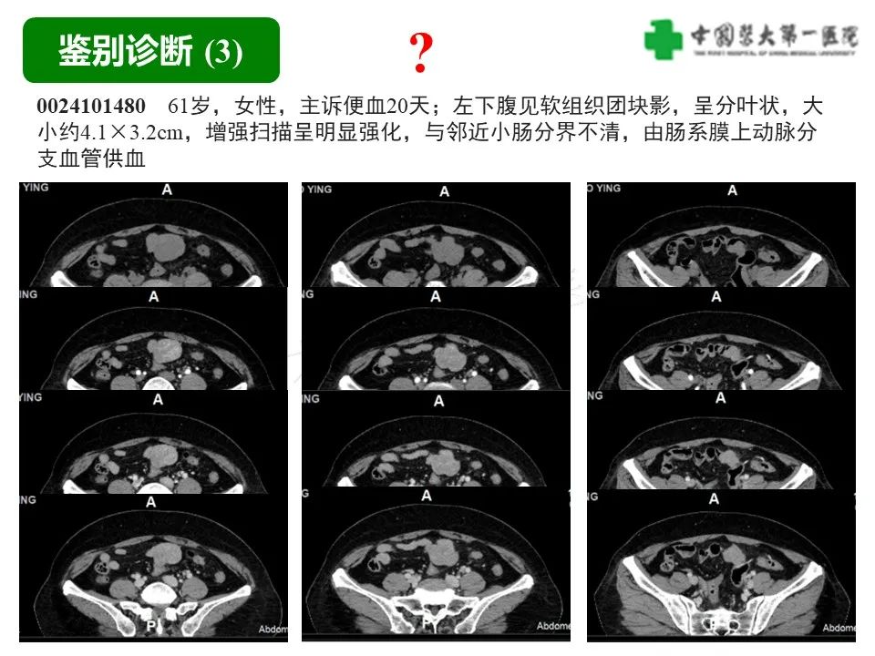 影像PPT - 【病例】肠道神经鞘瘤1例CT影像-24