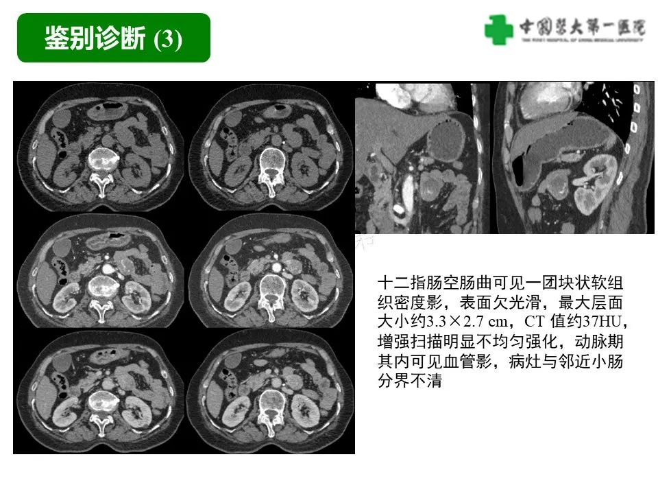 影像PPT - 【病例】肠道神经鞘瘤1例CT影像-27