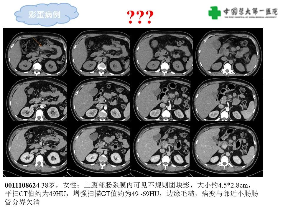影像PPT - 【病例】肠道神经鞘瘤1例CT影像-29