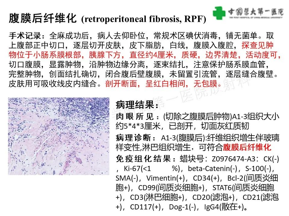 影像PPT - 【病例】肠道神经鞘瘤1例CT影像-30