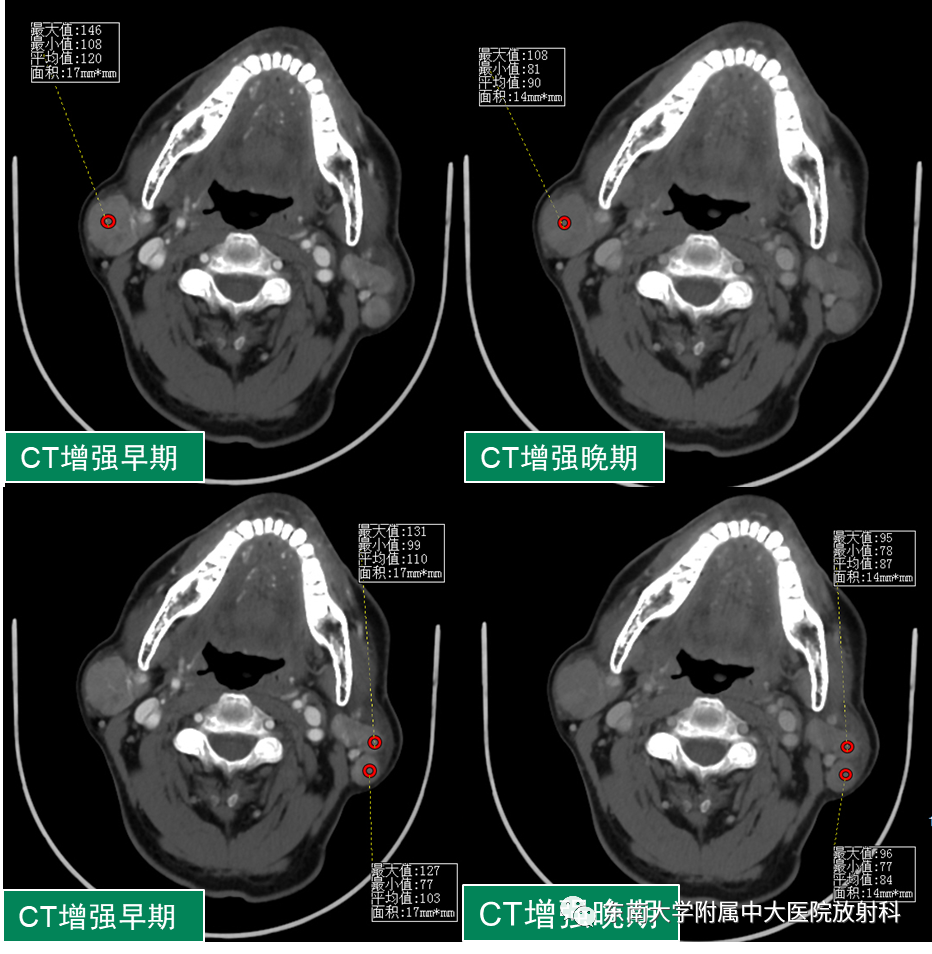 影像PPT - 【PPT】腮腺腺淋巴瘤(Warthin瘤)-1 影像PPT - 【PPT】腮腺腺淋巴瘤(Warthin瘤)-1