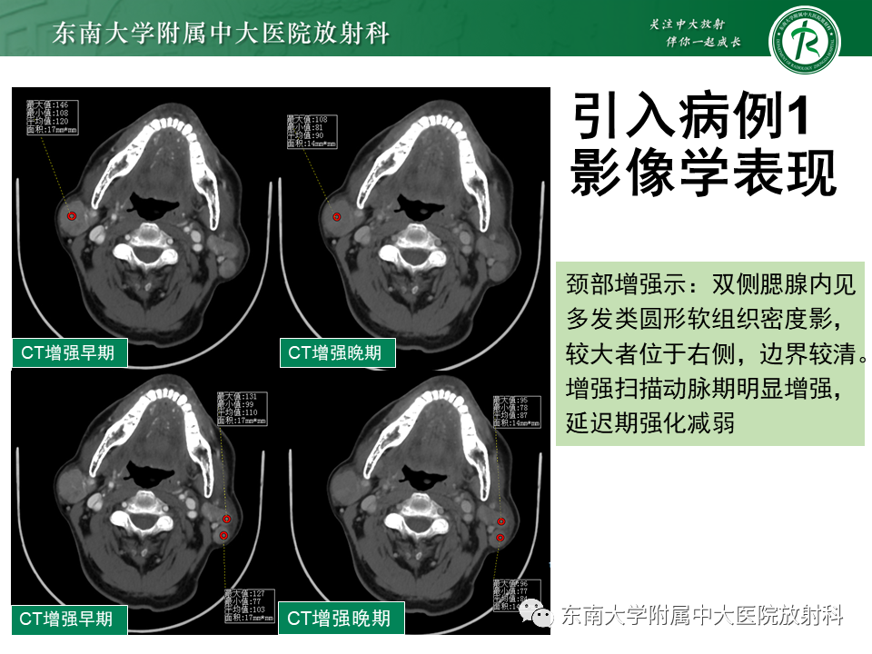 影像PPT - 【PPT】腮腺腺淋巴瘤(Warthin瘤)-2 影像PPT - 【PPT】腮腺腺淋巴瘤(Warthin瘤)-2