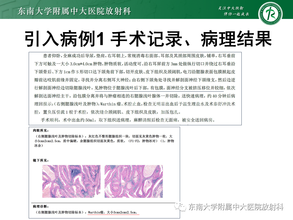影像PPT - 【PPT】腮腺腺淋巴瘤(Warthin瘤)-3 影像PPT - 【PPT】腮腺腺淋巴瘤(Warthin瘤)-3