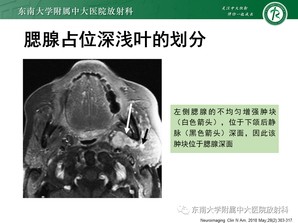 影像PPT - 【PPT】腮腺腺淋巴瘤(Warthin瘤)-9 影像PPT - 【PPT】腮腺腺淋巴瘤(Warthin瘤)-9