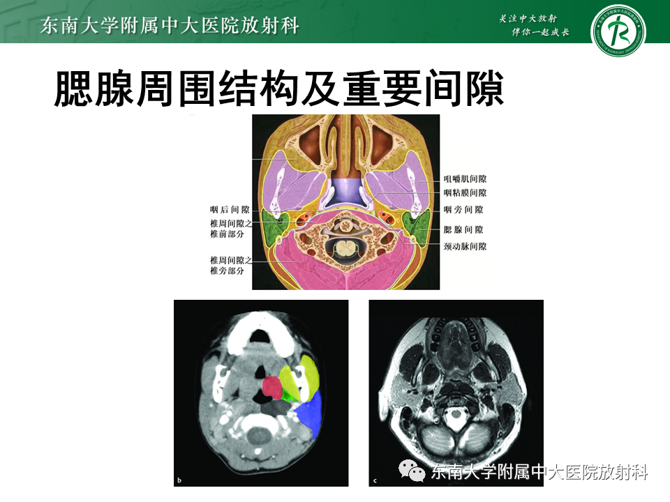 影像PPT - 【PPT】腮腺腺淋巴瘤(Warthin瘤)-11 影像PPT - 【PPT】腮腺腺淋巴瘤(Warthin瘤)-11