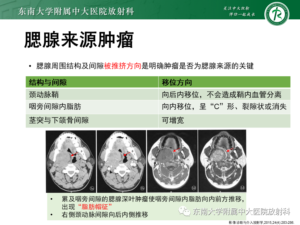影像PPT - 【PPT】腮腺腺淋巴瘤(Warthin瘤)-12 影像PPT - 【PPT】腮腺腺淋巴瘤(Warthin瘤)-12