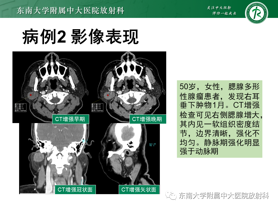 影像PPT - 【PPT】腮腺腺淋巴瘤(Warthin瘤)-26 影像PPT - 【PPT】腮腺腺淋巴瘤(Warthin瘤)-26