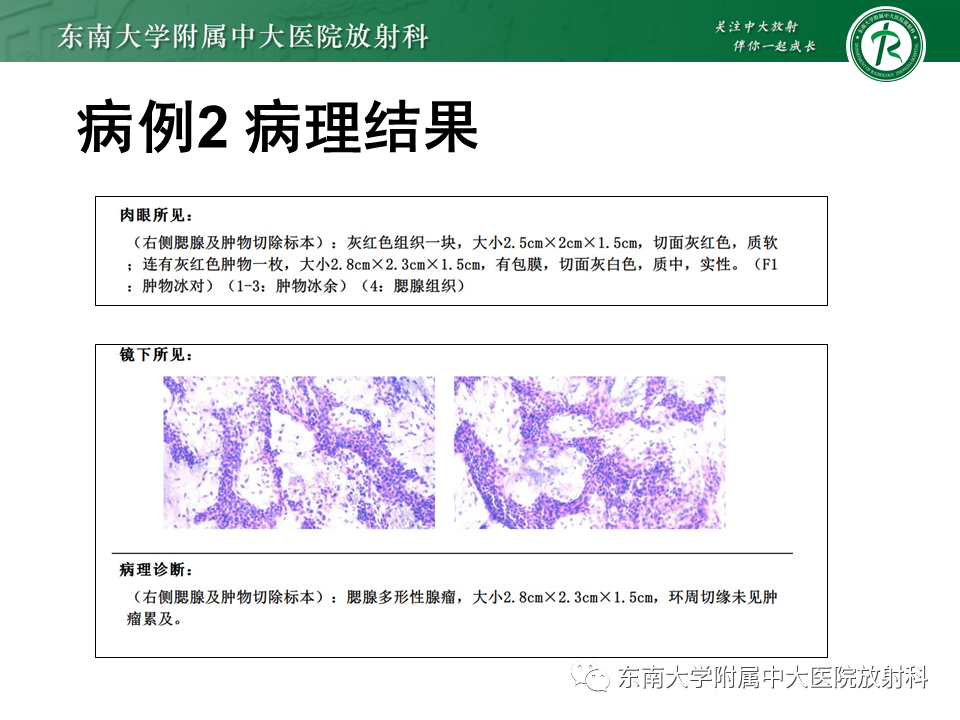 影像PPT - 【PPT】腮腺腺淋巴瘤(Warthin瘤)-27 影像PPT - 【PPT】腮腺腺淋巴瘤(Warthin瘤)-27