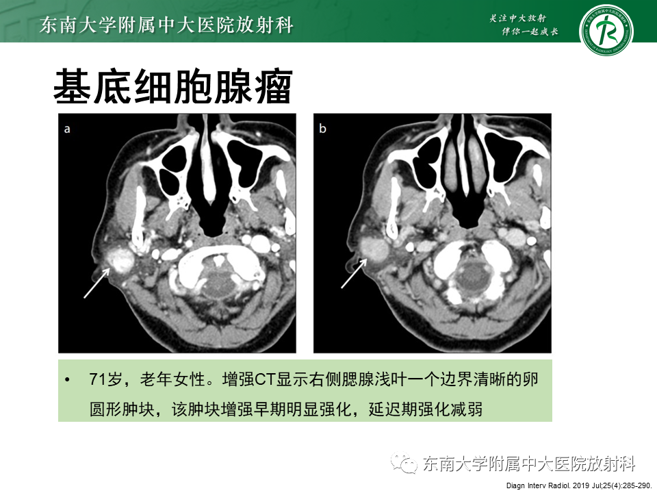 影像PPT - 【PPT】腮腺腺淋巴瘤(Warthin瘤)-29 影像PPT - 【PPT】腮腺腺淋巴瘤(Warthin瘤)-29