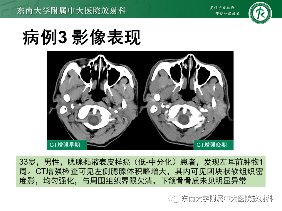 影像PPT - 【PPT】腮腺腺淋巴瘤(Warthin瘤)-33 影像PPT - 【PPT】腮腺腺淋巴瘤(Warthin瘤)-33