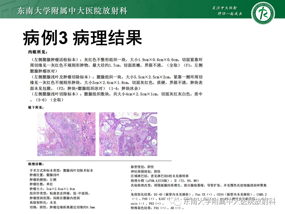 影像PPT - 【PPT】腮腺腺淋巴瘤(Warthin瘤)-34 影像PPT - 【PPT】腮腺腺淋巴瘤(Warthin瘤)-34