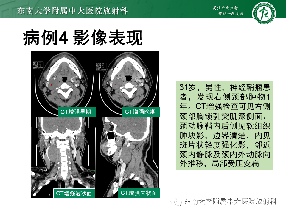 影像PPT - 【PPT】腮腺腺淋巴瘤(Warthin瘤)-38 影像PPT - 【PPT】腮腺腺淋巴瘤(Warthin瘤)-38
