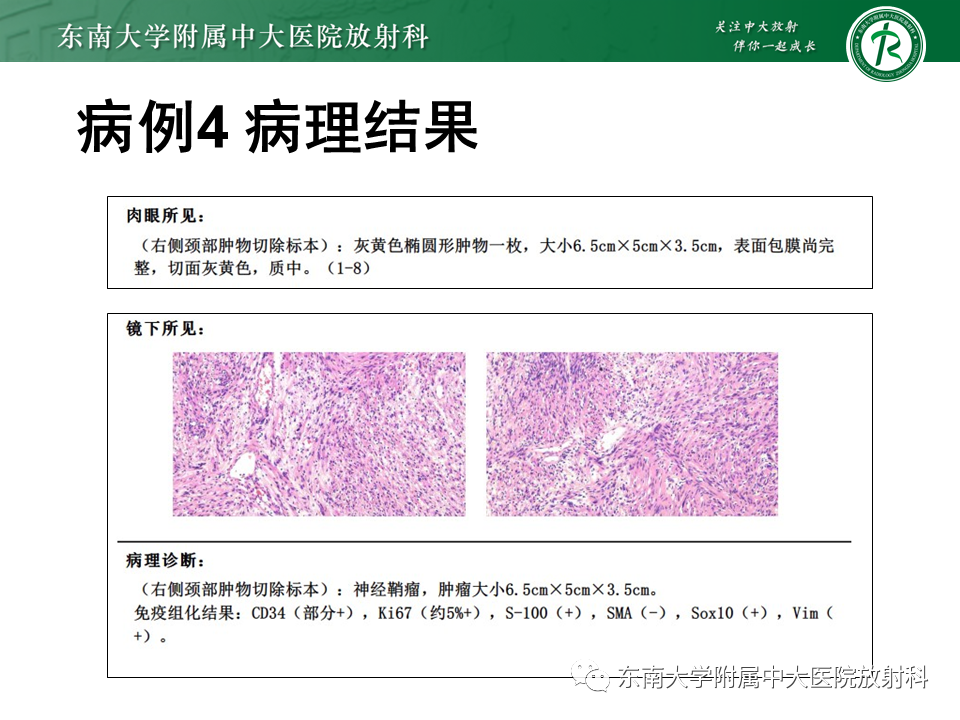 影像PPT - 【PPT】腮腺腺淋巴瘤(Warthin瘤)-39 影像PPT - 【PPT】腮腺腺淋巴瘤(Warthin瘤)-39