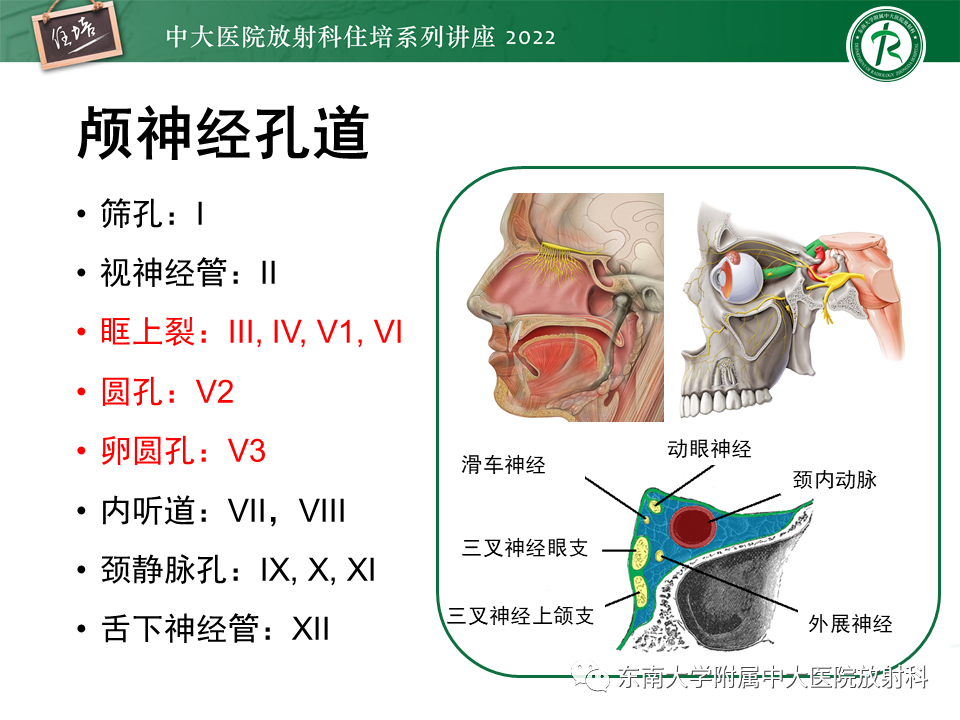 影像PPT - 【PPT】颅神经成像及常见病变-3