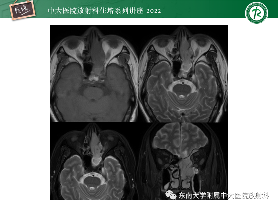 影像PPT - 【PPT】颅神经成像及常见病变-8