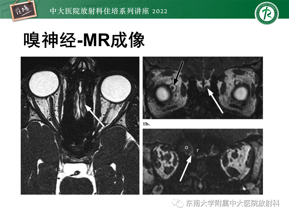 影像PPT - 【PPT】颅神经成像及常见病变-6