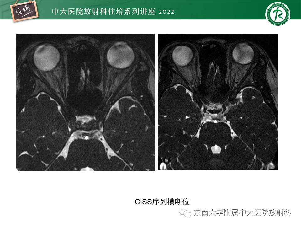 影像PPT - 【PPT】颅神经成像及常见病变-14