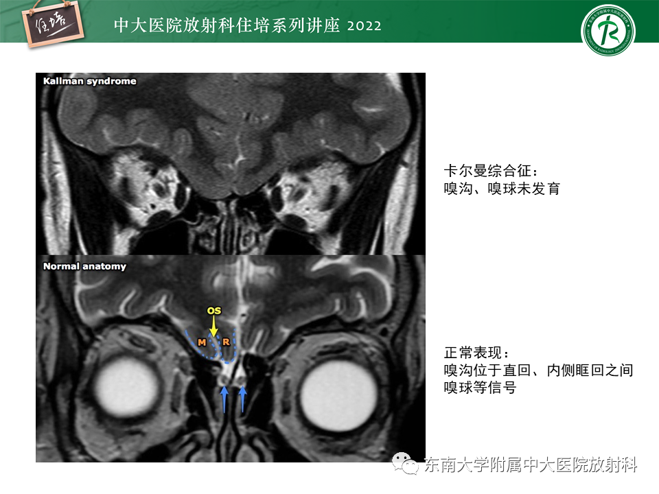 影像PPT - 【PPT】颅神经成像及常见病变-17
