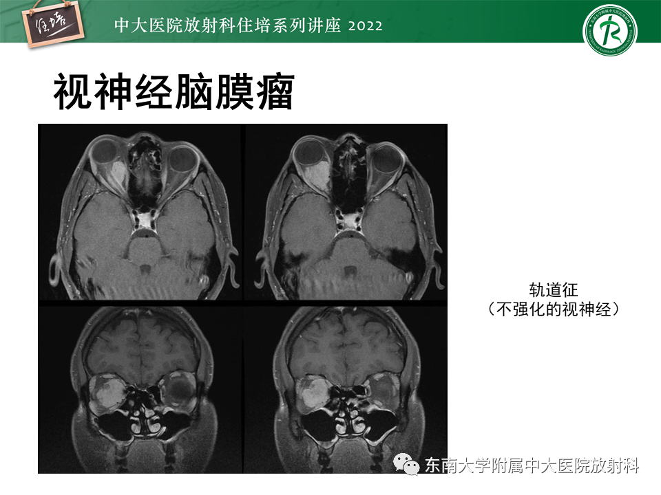 影像PPT - 【PPT】颅神经成像及常见病变-20