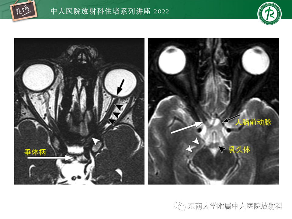 影像PPT - 【PPT】颅神经成像及常见病变-19