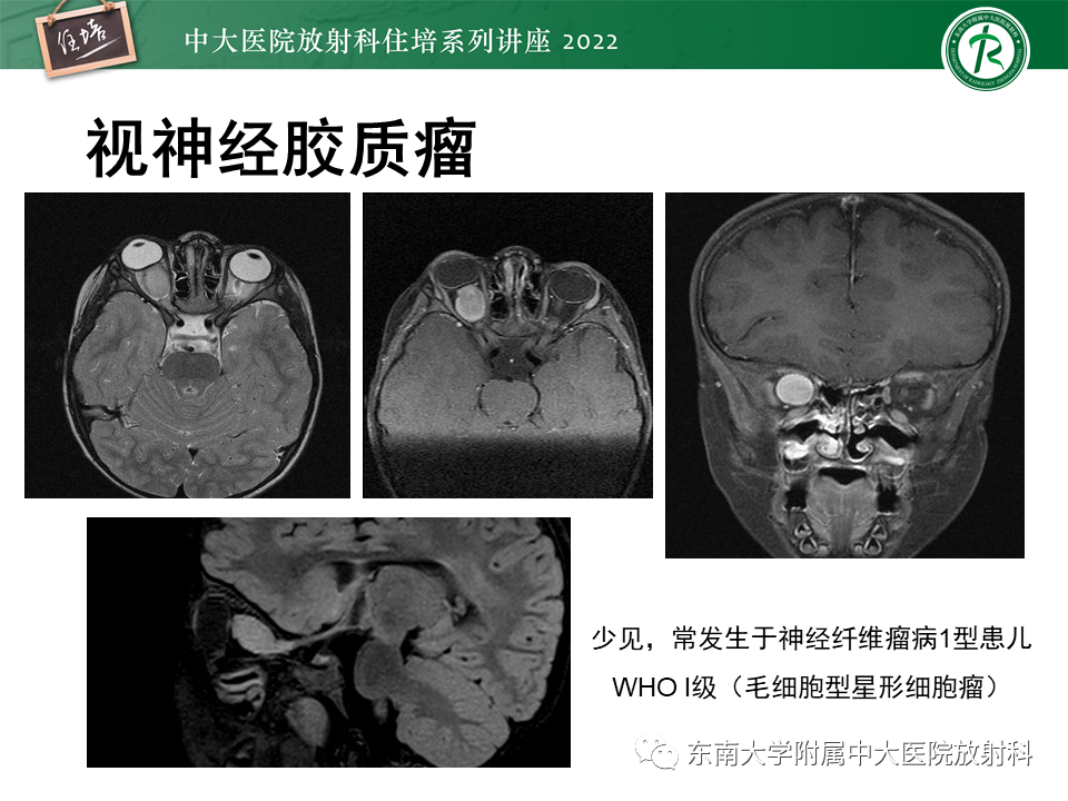 影像PPT - 【PPT】颅神经成像及常见病变-21
