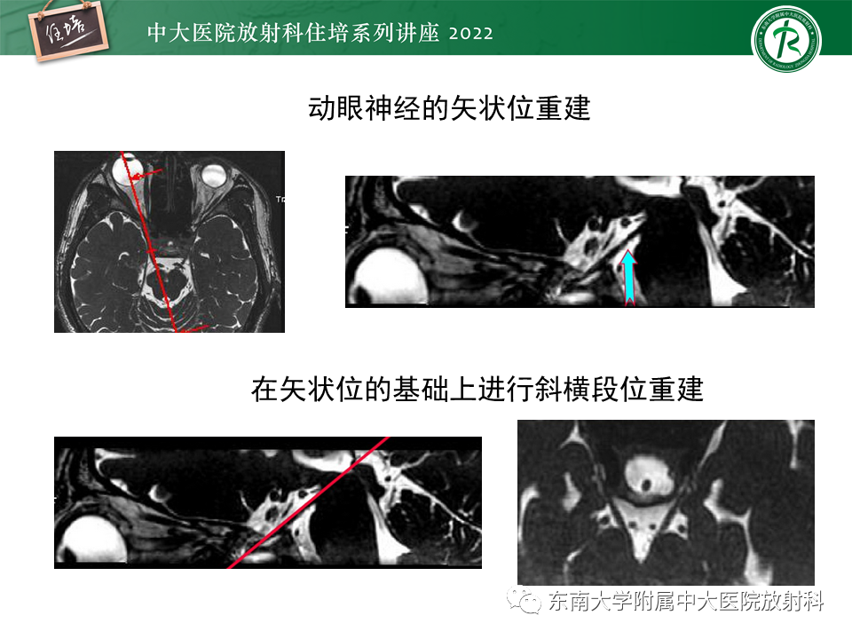 影像PPT - 【PPT】颅神经成像及常见病变-24