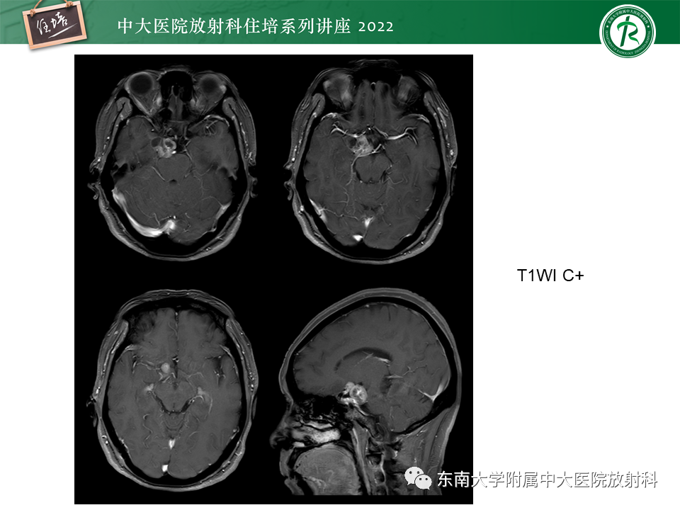 影像PPT - 【PPT】颅神经成像及常见病变-27
