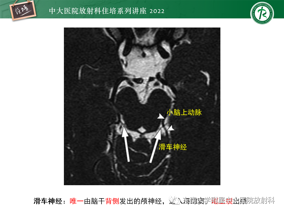 影像PPT - 【PPT】颅神经成像及常见病变-30