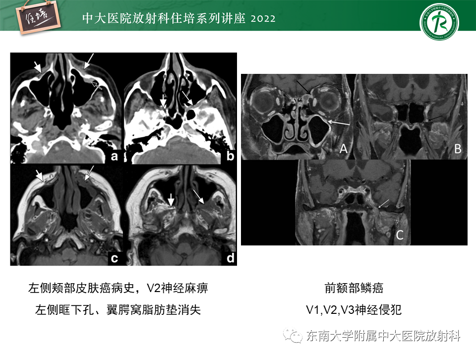 影像PPT - 【PPT】颅神经成像及常见病变-42