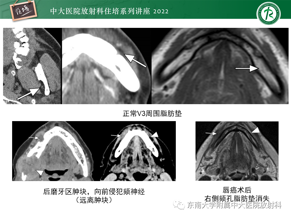 影像PPT - 【PPT】颅神经成像及常见病变-43