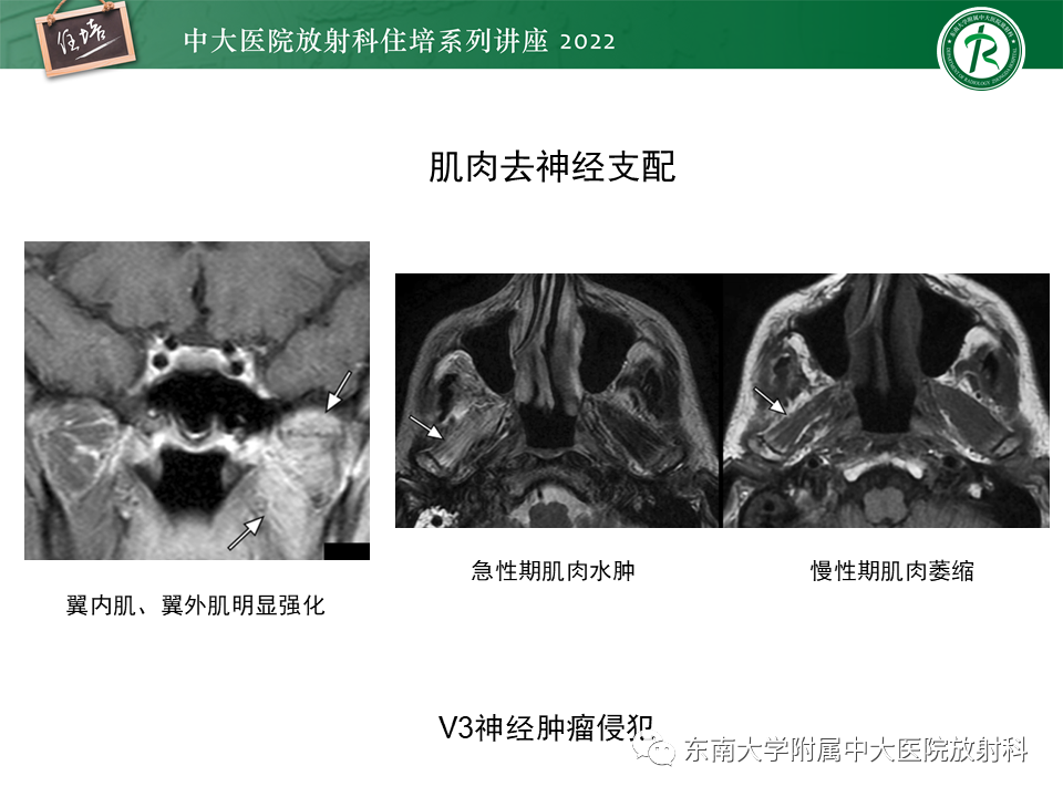 影像PPT - 【PPT】颅神经成像及常见病变-44