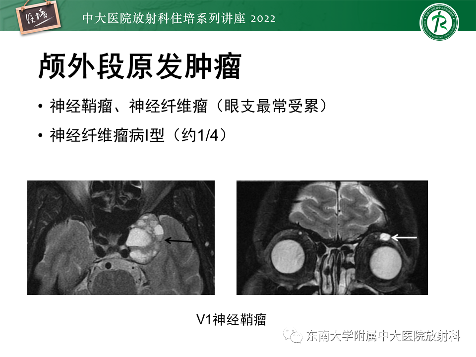 影像PPT - 【PPT】颅神经成像及常见病变-45
