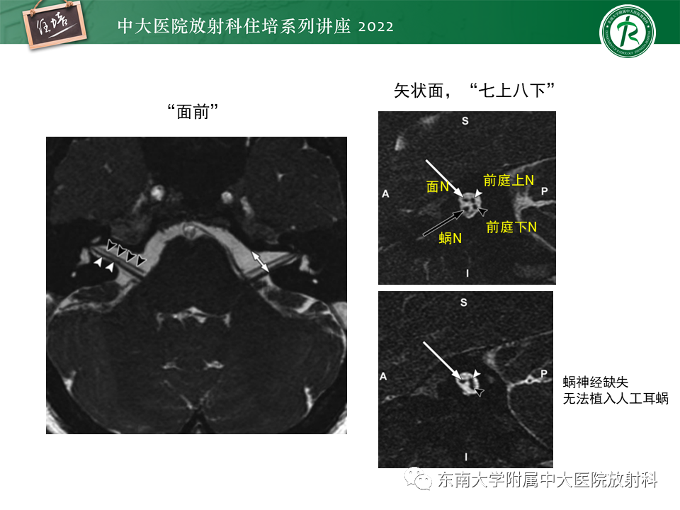 影像PPT - 【PPT】颅神经成像及常见病变-48