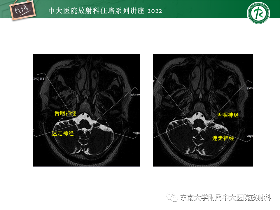 影像PPT - 【PPT】颅神经成像及常见病变-52