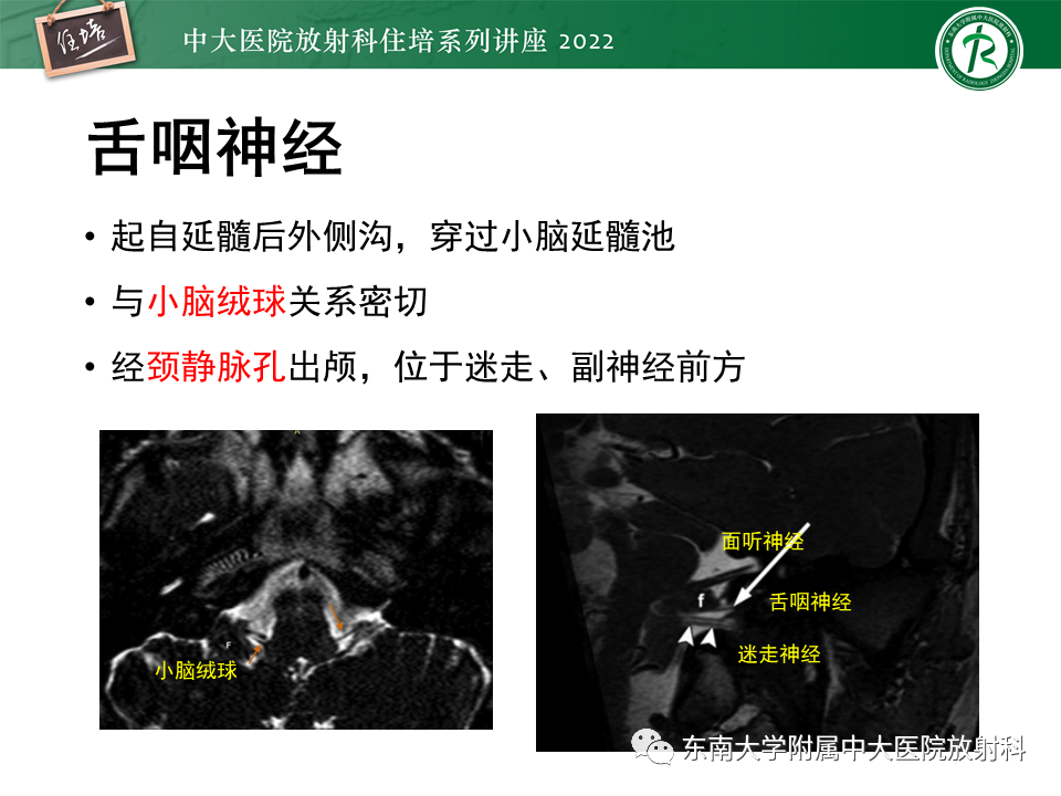 影像PPT - 【PPT】颅神经成像及常见病变-50